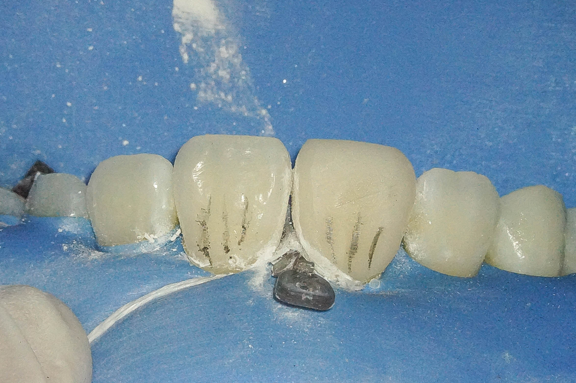 前歯が変色している状態に対してダイレクトボンディングにて対応した症例治療方法11