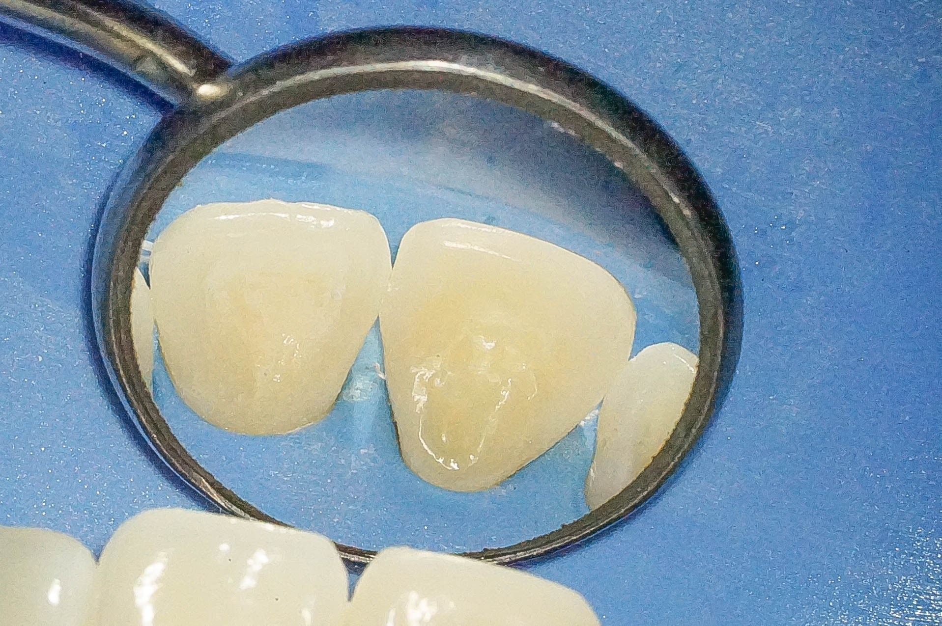 前歯が変色している状態に対してダイレクトボンディングにて対応した症例治療方法13