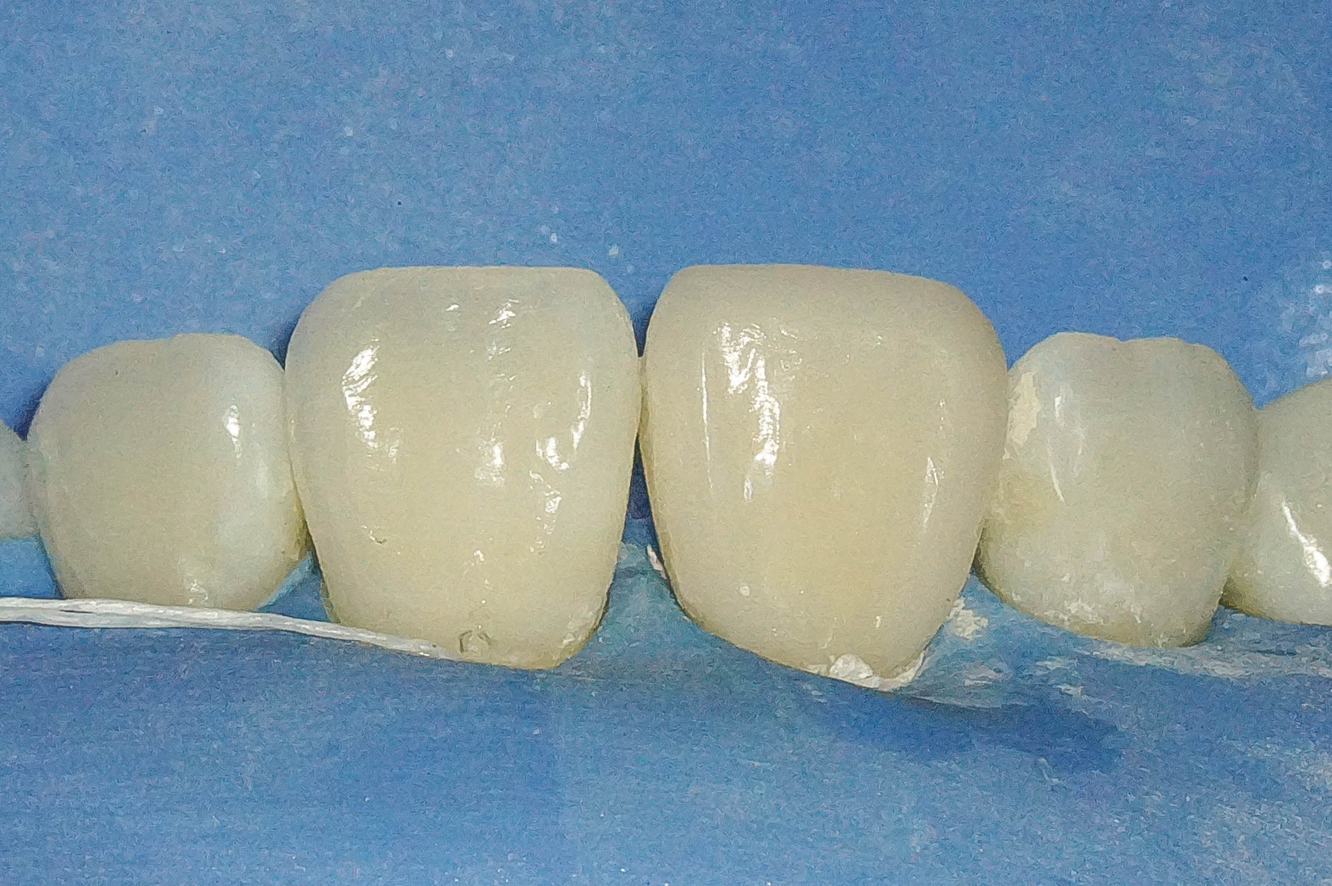 前歯が変色している状態に対してダイレクトボンディングにて対応した症例治療方法12