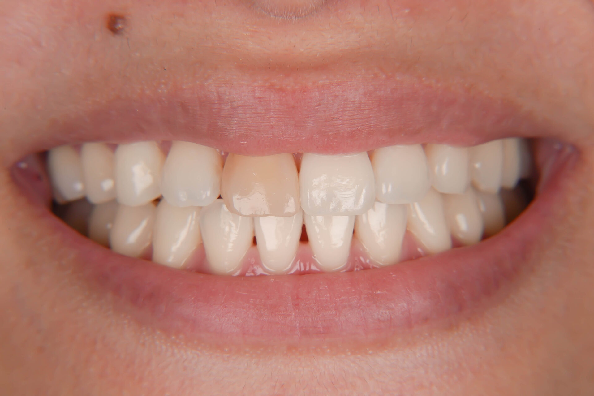 前歯が変色している状態に対してダイレクトボンディングにて対応した症例BEFORE