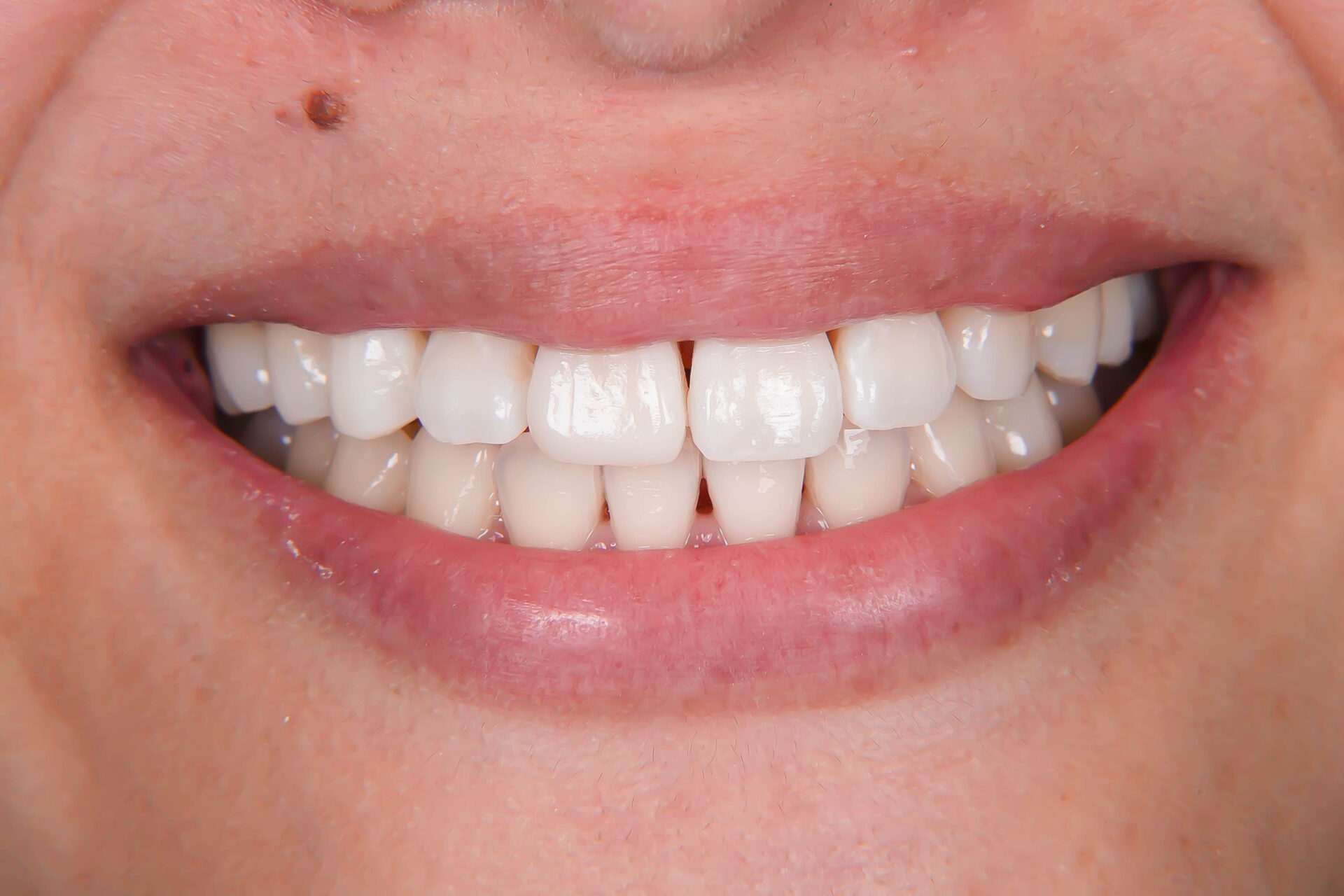 前歯が変色している状態に対してダイレクトボンディングにて対応した症例