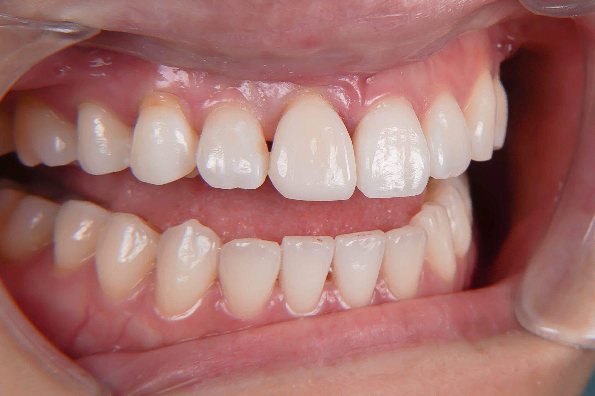 前歯が変色している状態に対してダイレクトボンディングにて対応した症例治療方法16