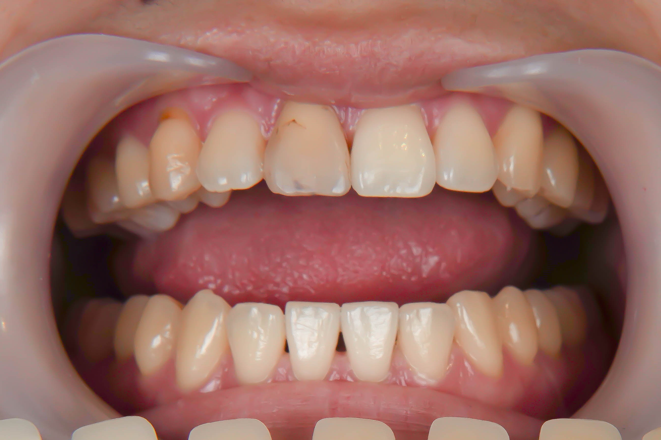 前歯が変色している状態に対してダイレクトボンディングにて対応した症例治療方法02