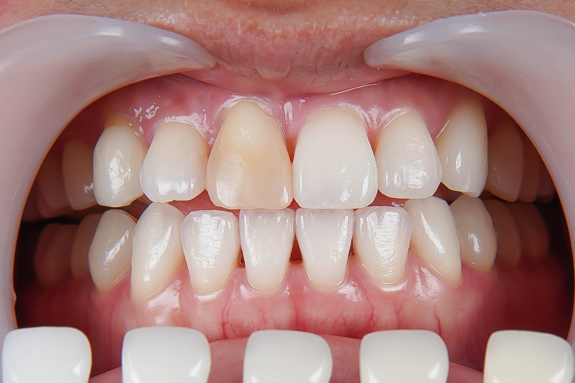 前歯が変色している状態に対してダイレクトボンディングにて対応した症例治療方法03