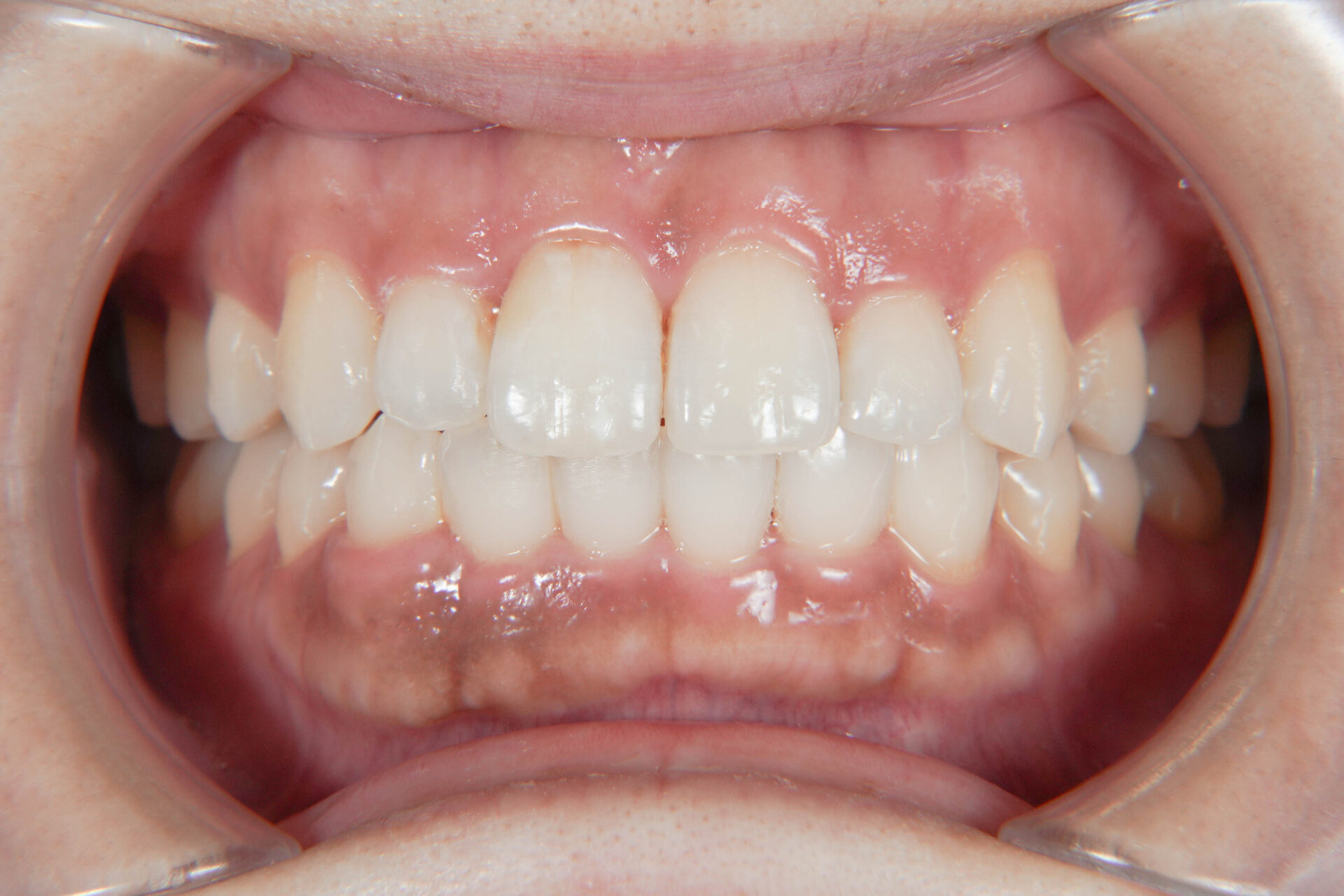 歯のガタガタと変色を改善　インビザライン＋ホワイトニング