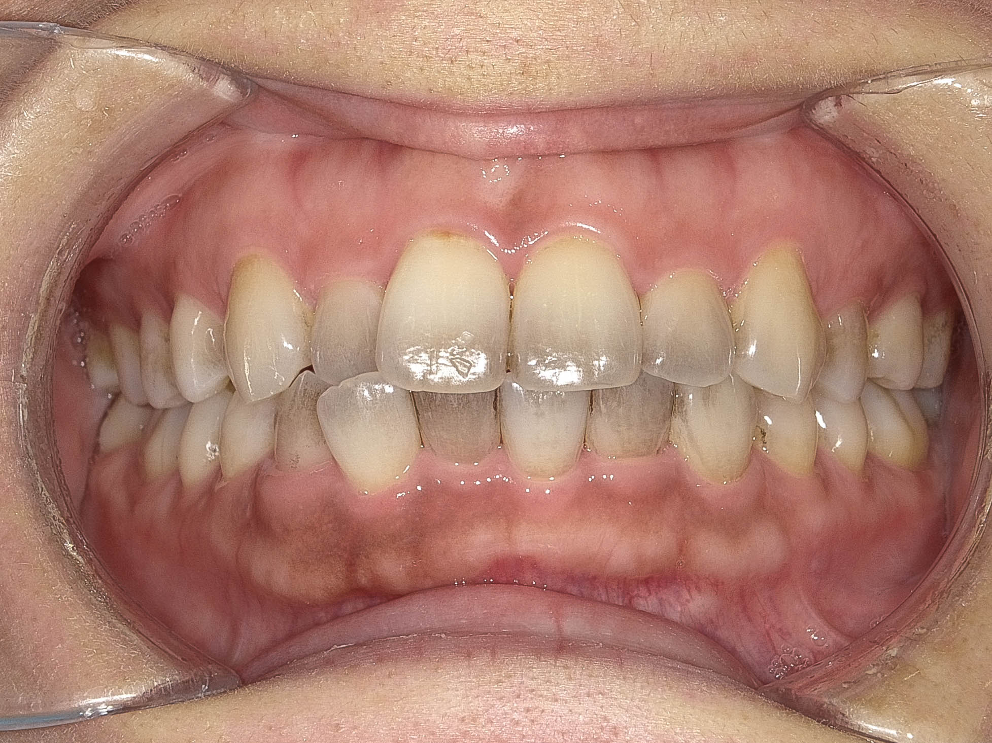 歯のガタガタと変色を改善　インビザライン＋ホワイトニングBEFORE