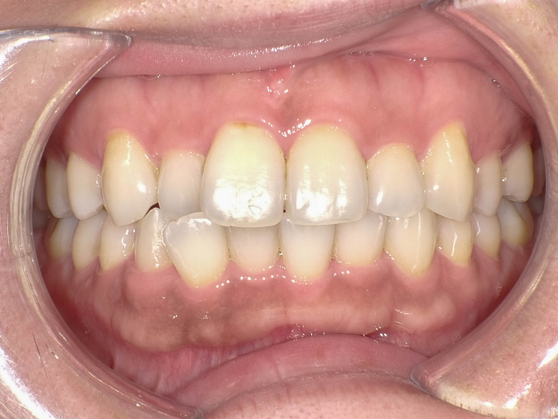 歯のガタガタと変色を改善　インビザライン＋ホワイトニング治療方法02
