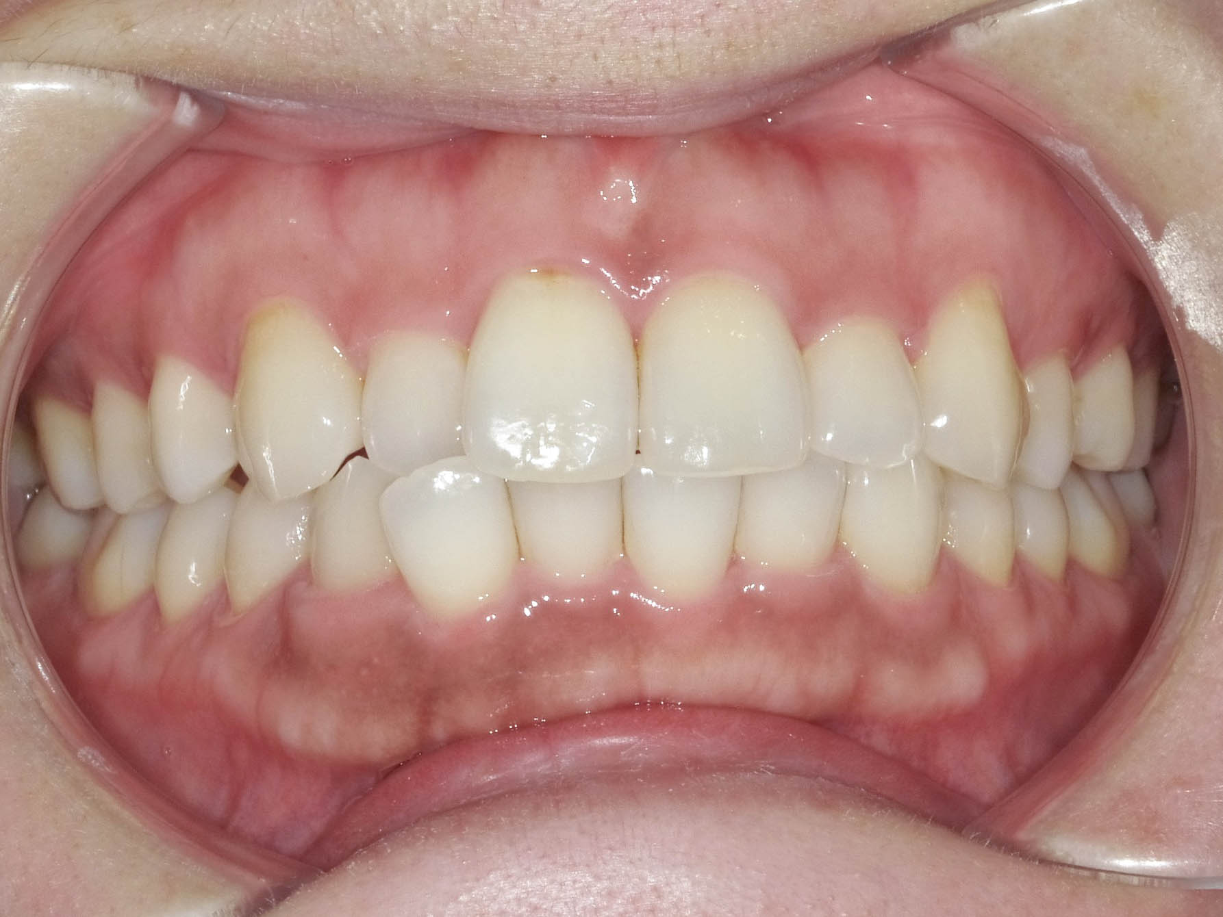 歯のガタガタと変色を改善　インビザライン＋ホワイトニング治療方法03