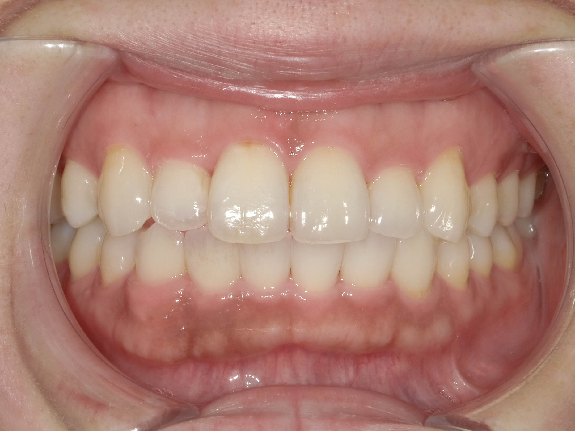 歯のガタガタと変色を改善　インビザライン＋ホワイトニング治療方法04