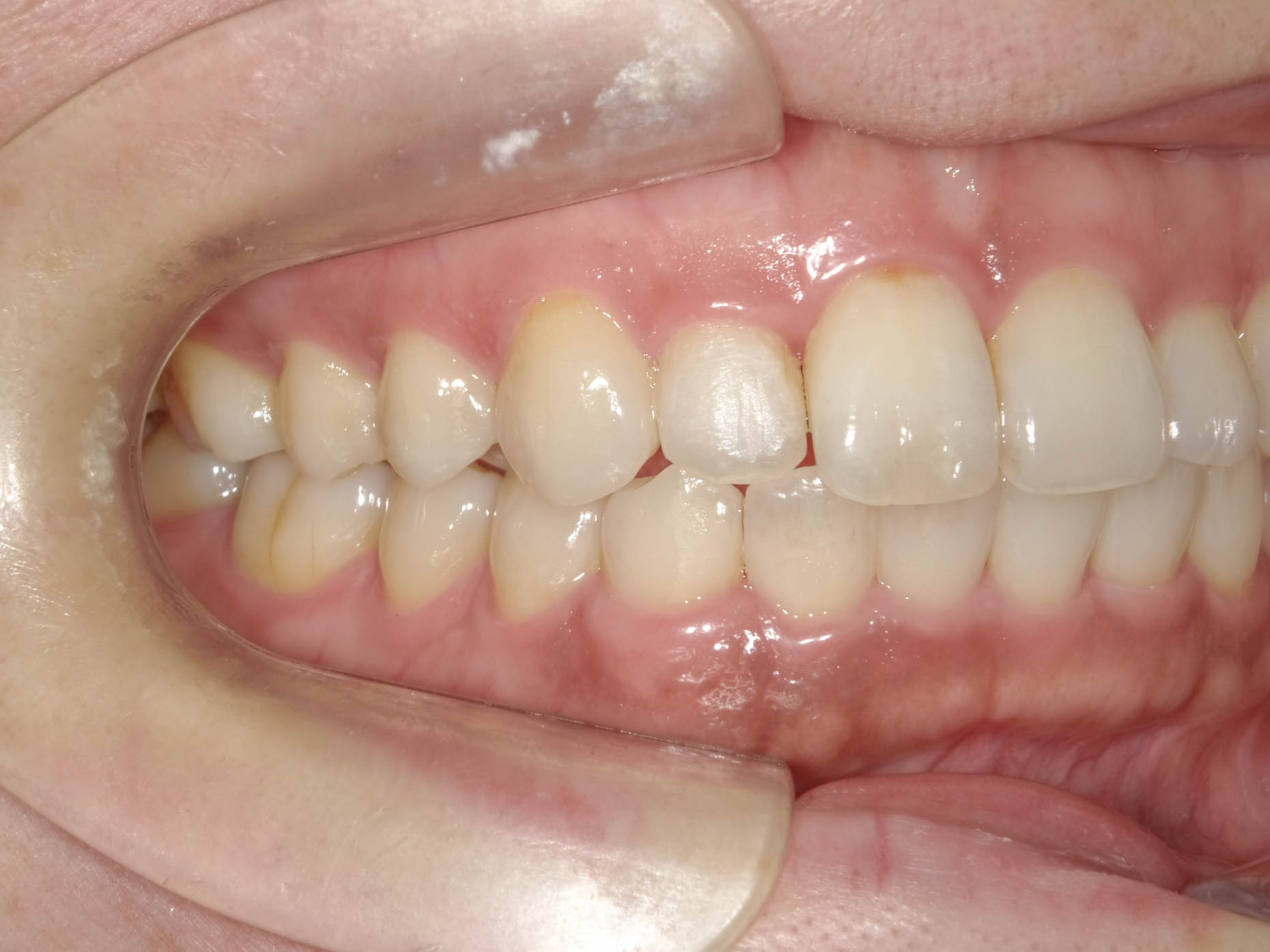 歯のガタガタと変色を改善　インビザライン＋ホワイトニング治療方法05