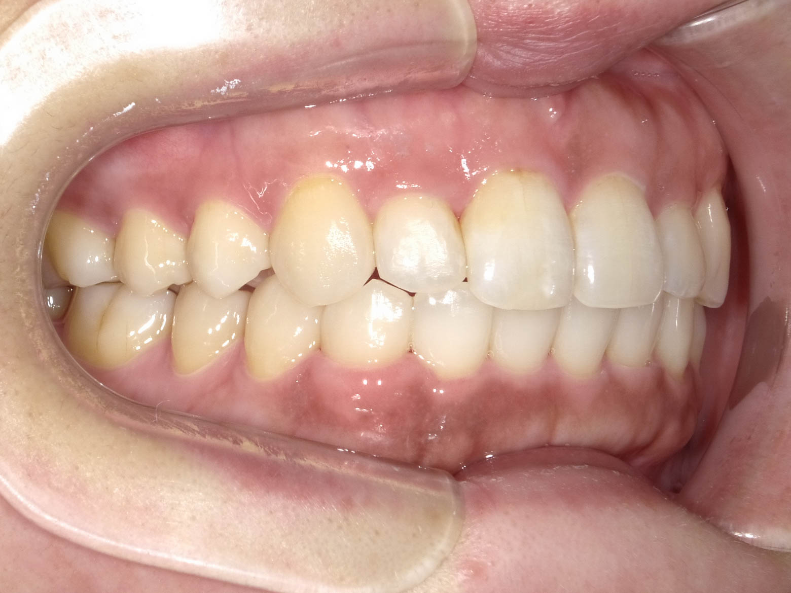 歯のガタガタと変色を改善　インビザライン＋ホワイトニング治療方法07