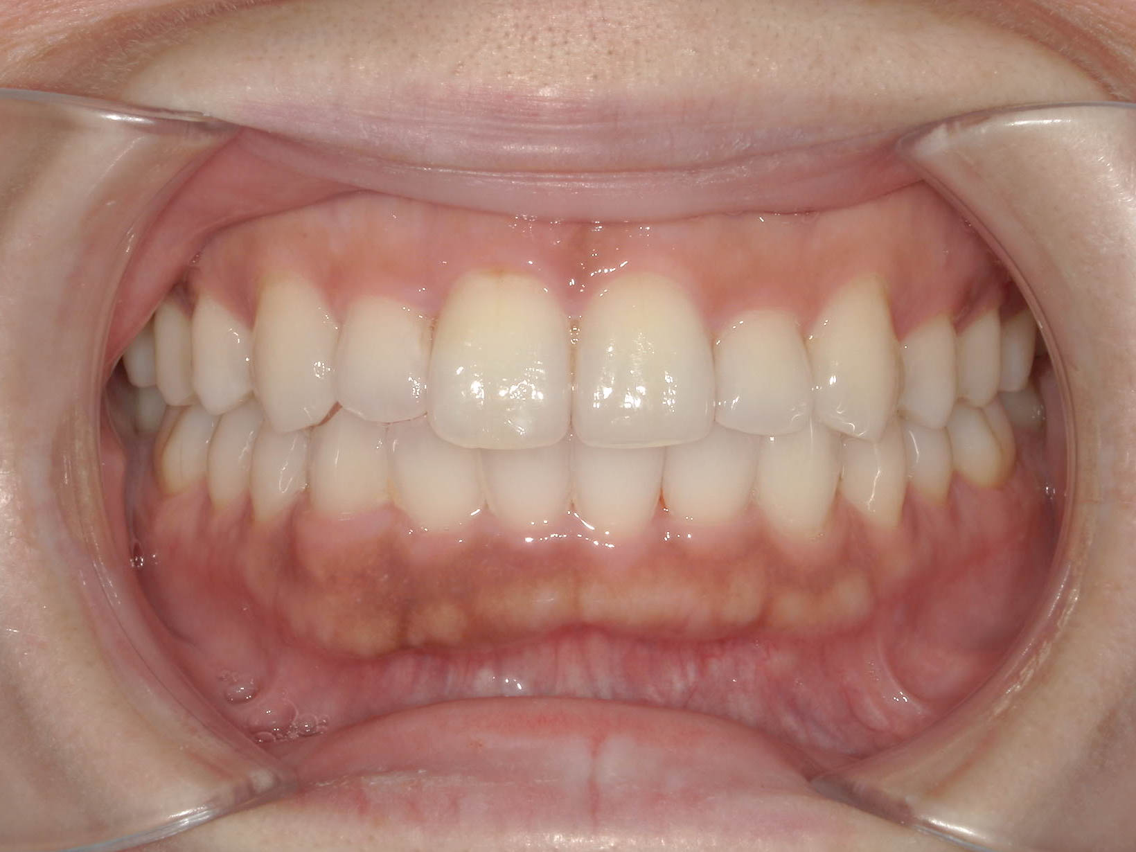 歯のガタガタと変色を改善　インビザライン＋ホワイトニング治療方法06