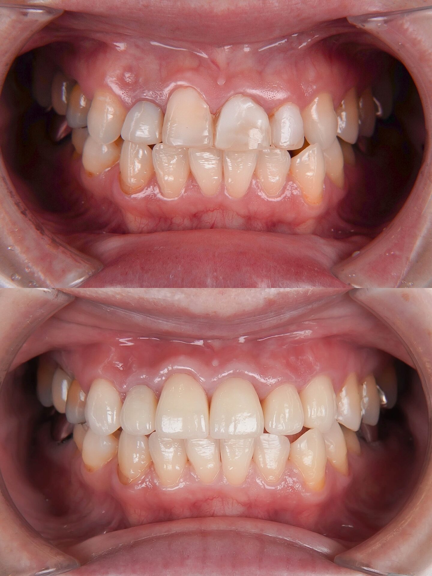 セラミック治療で色や形を改善したケース治療方法10