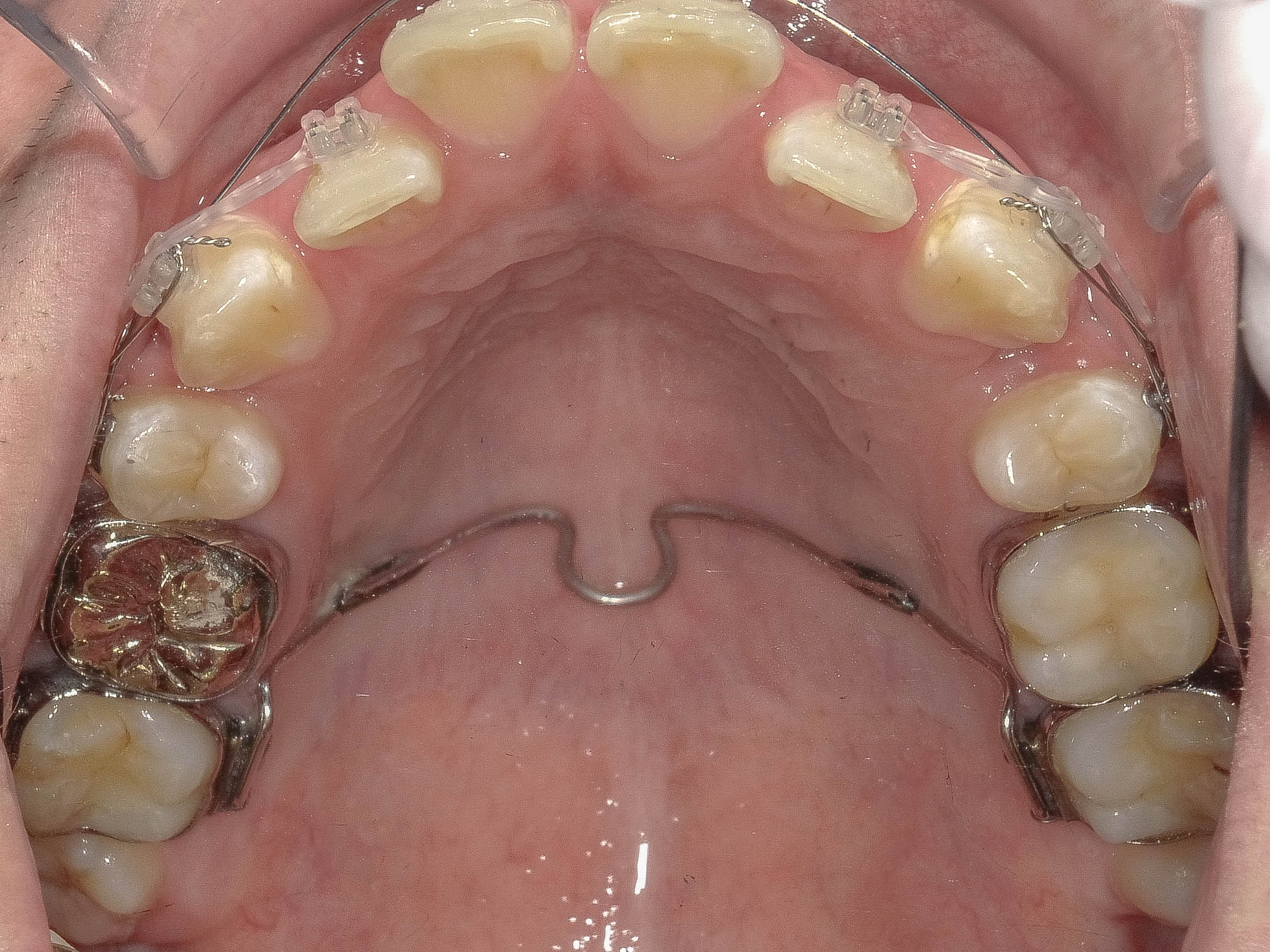 上顎前突（出っ歯）の矯正治療治療方法06