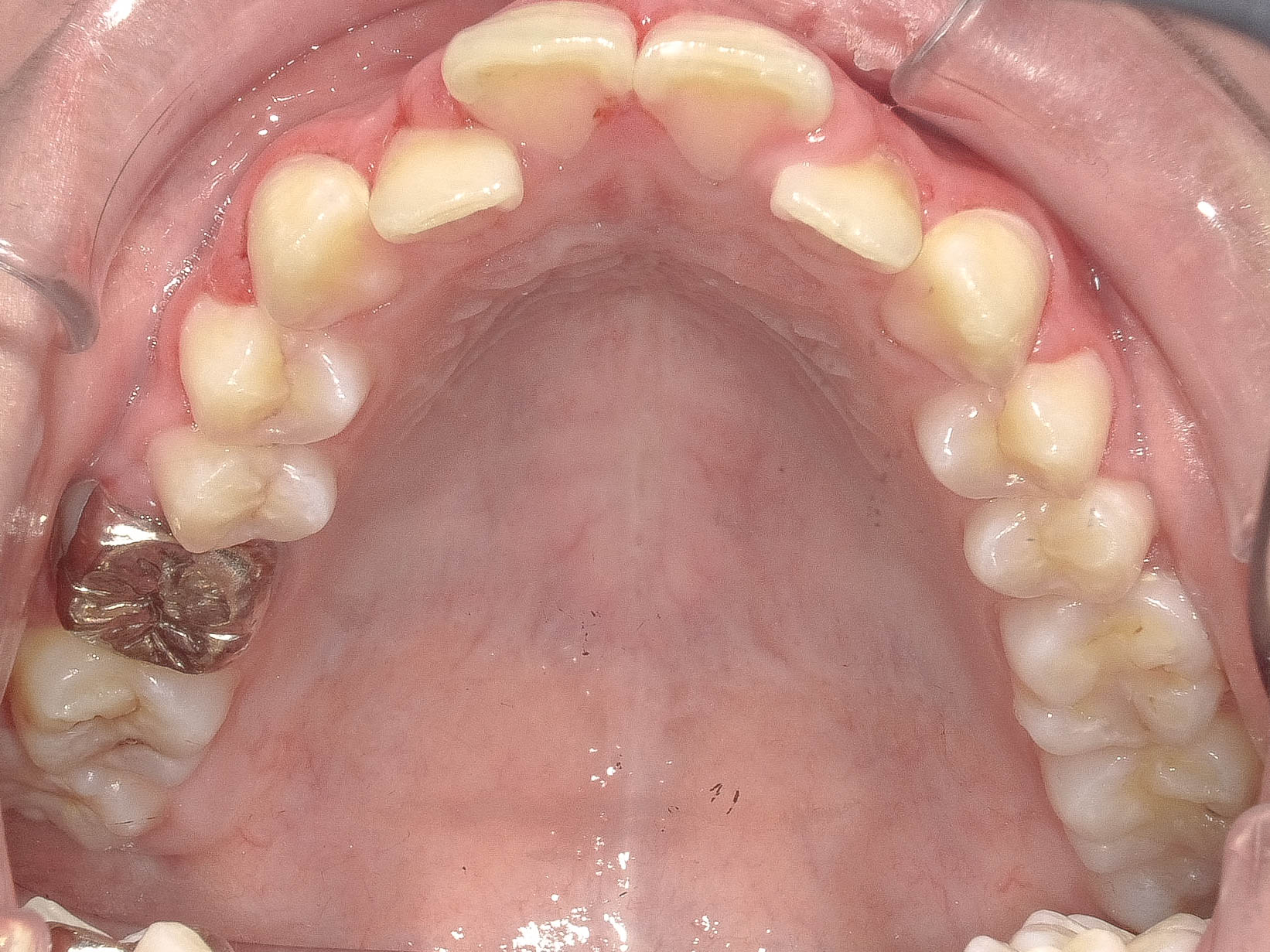 上顎前突（出っ歯）の矯正治療治療方法02