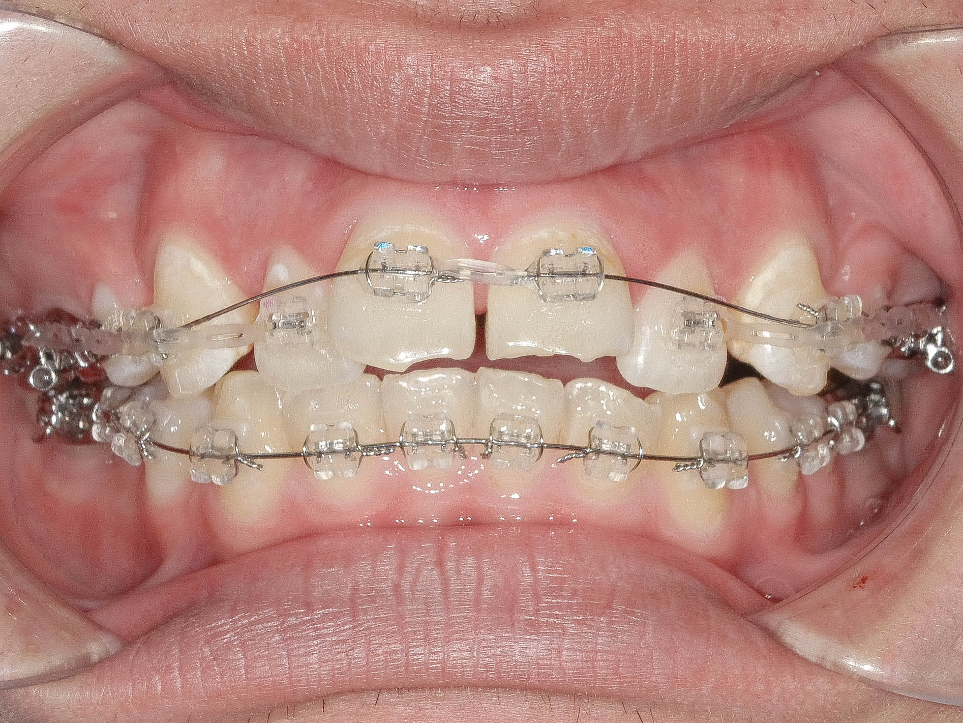 上顎前突（出っ歯）の矯正治療治療方法05