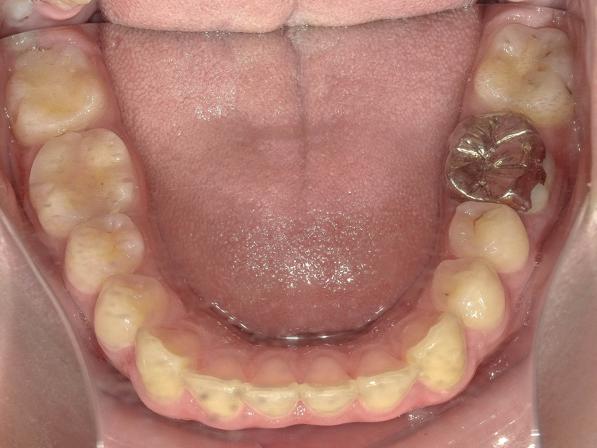 上顎前突（出っ歯）の矯正治療治療方法09