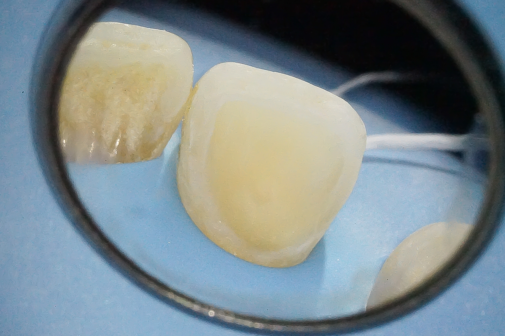 歯を削らないブリッジ（※正確にはほんの少しだけ削ります）　接着ブリッジ治療方法04
