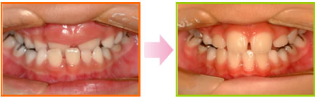 ”小児一次矯正　治療期間：8ヶ月　8歳女子"