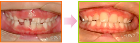 ”咬合誘導　治療期間：1年3ヶ月　8歳男子"