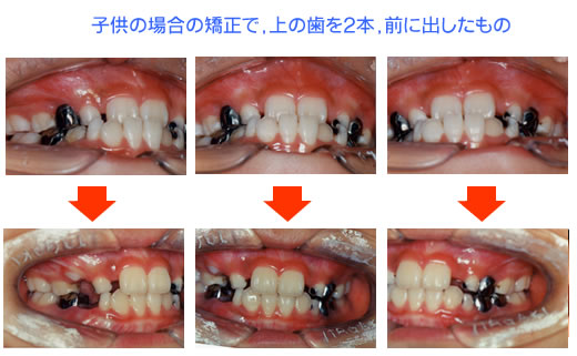 ”反対咬合　治療期間：5ヶ月"