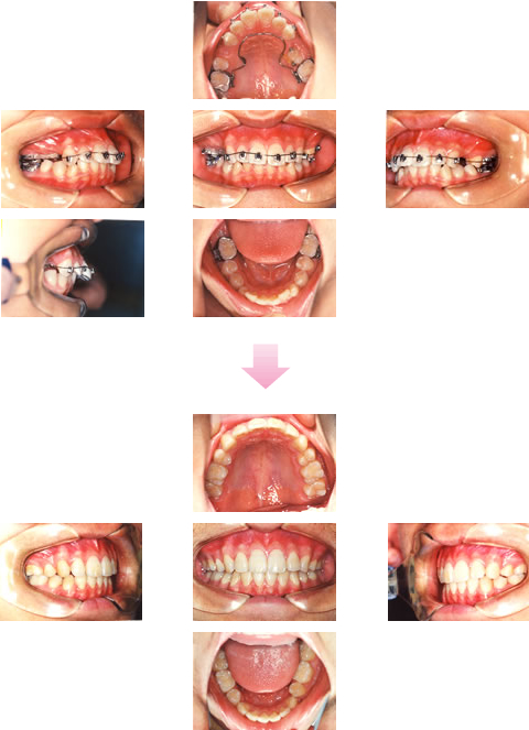 出っ歯（上顎前突） 治療期間 約2年7ヶ月