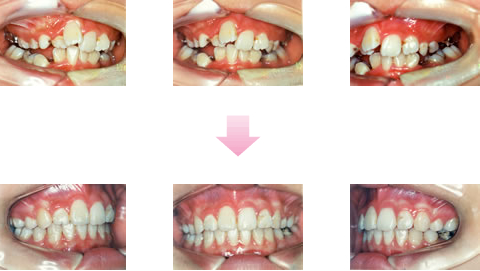 デコボコ歯並び（叢生） 治療期間 約2年3ヶ月 10歳女性