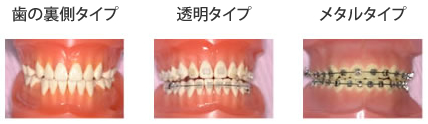 マルチブラケット装置の種類