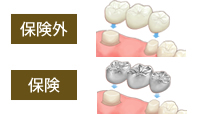 インプラント