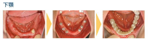 症例2.50代女性下顎6本　治療期間6ヶ月