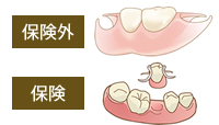 インプラント