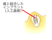 インプラント：フィクスチャー埋入