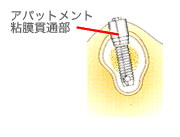 治癒期間：オッセオインテグレーション（骨結合）