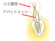 アパットメント連結（歯冠の土台）