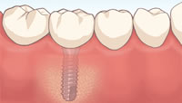 インプラント