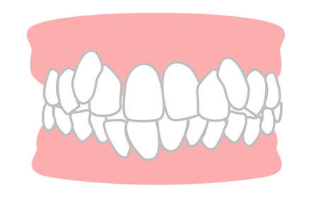 叢生(ガタガタの歯並び)