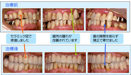 歯周病・部分矯正・セラミック総合治療　50代男性