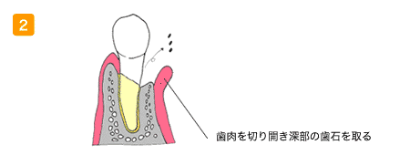 歯石を取る