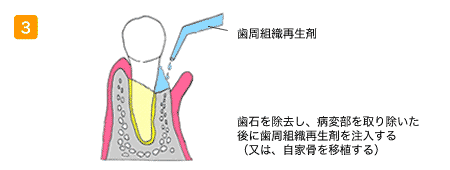 歯周組織再生剤
