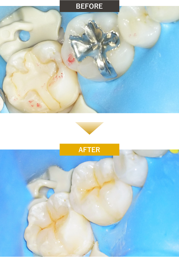 銀歯を白い歯に変える治療前後