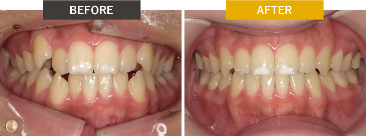 セラミック治療の前後