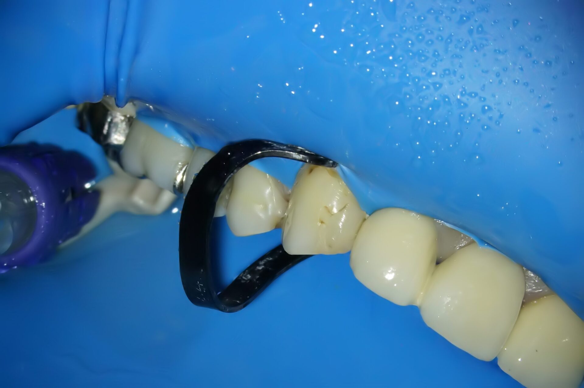 虫歯治療2治療方法02