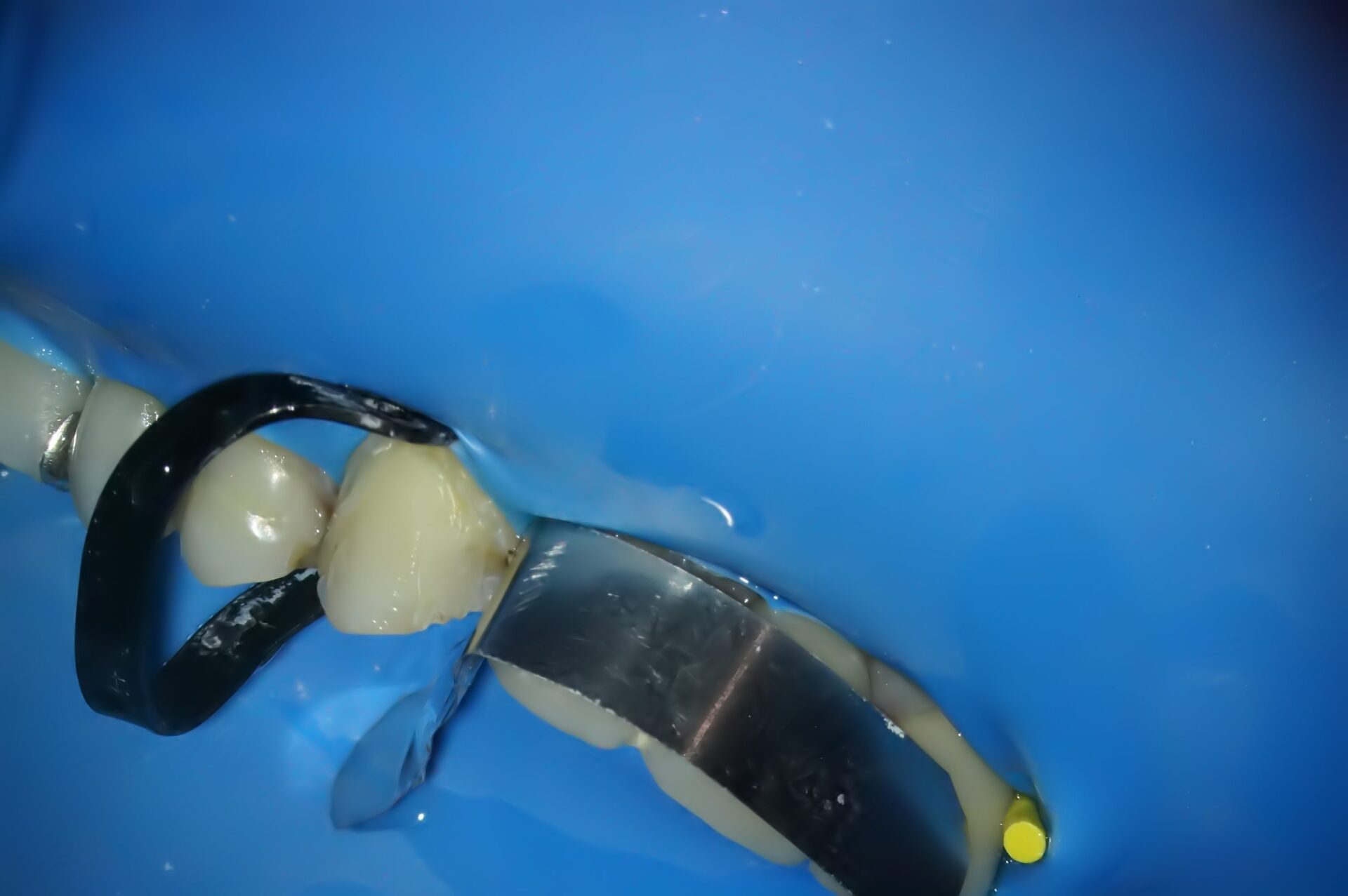 虫歯治療2治療方法03