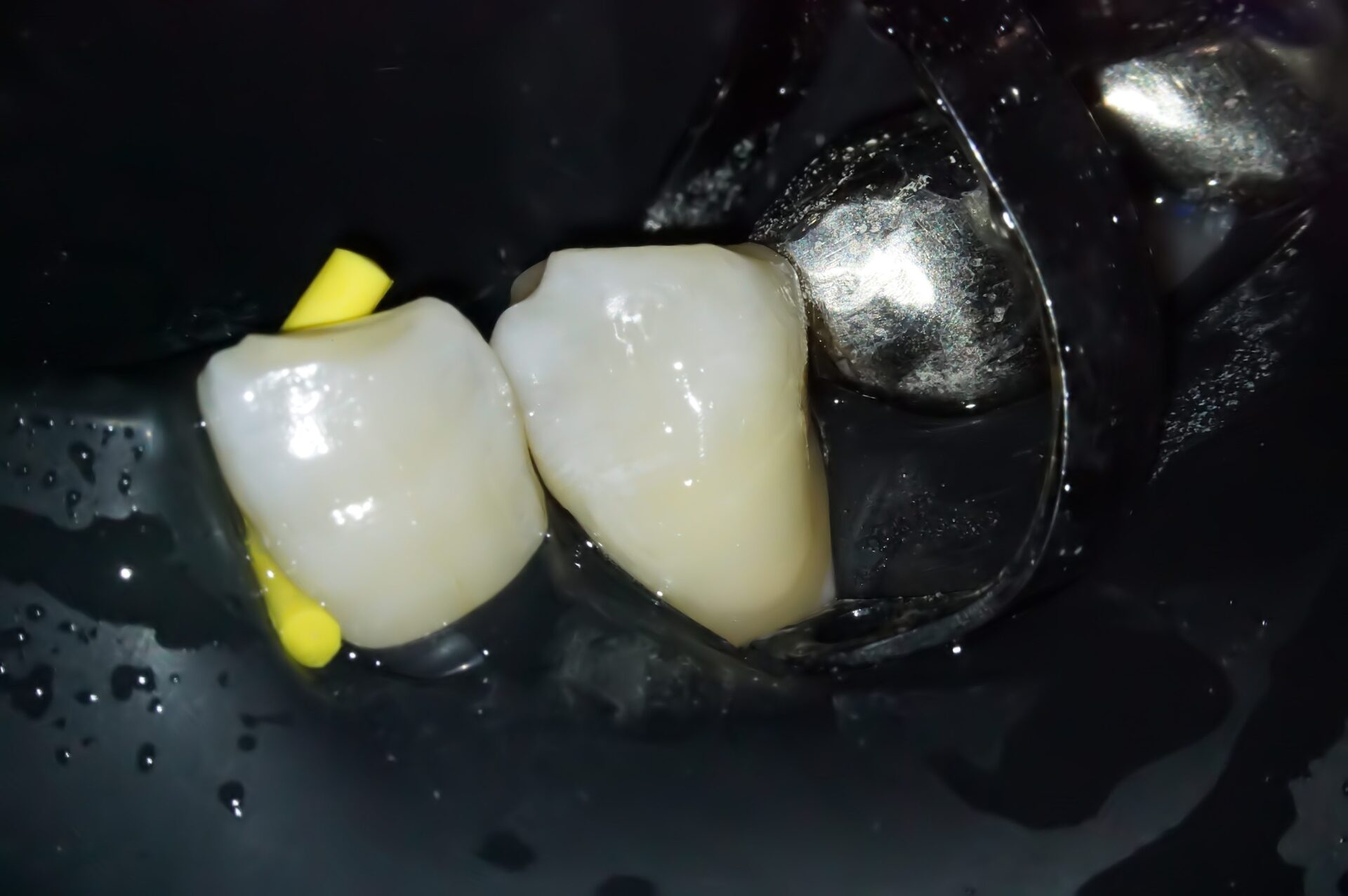 虫歯治療1治療方法05