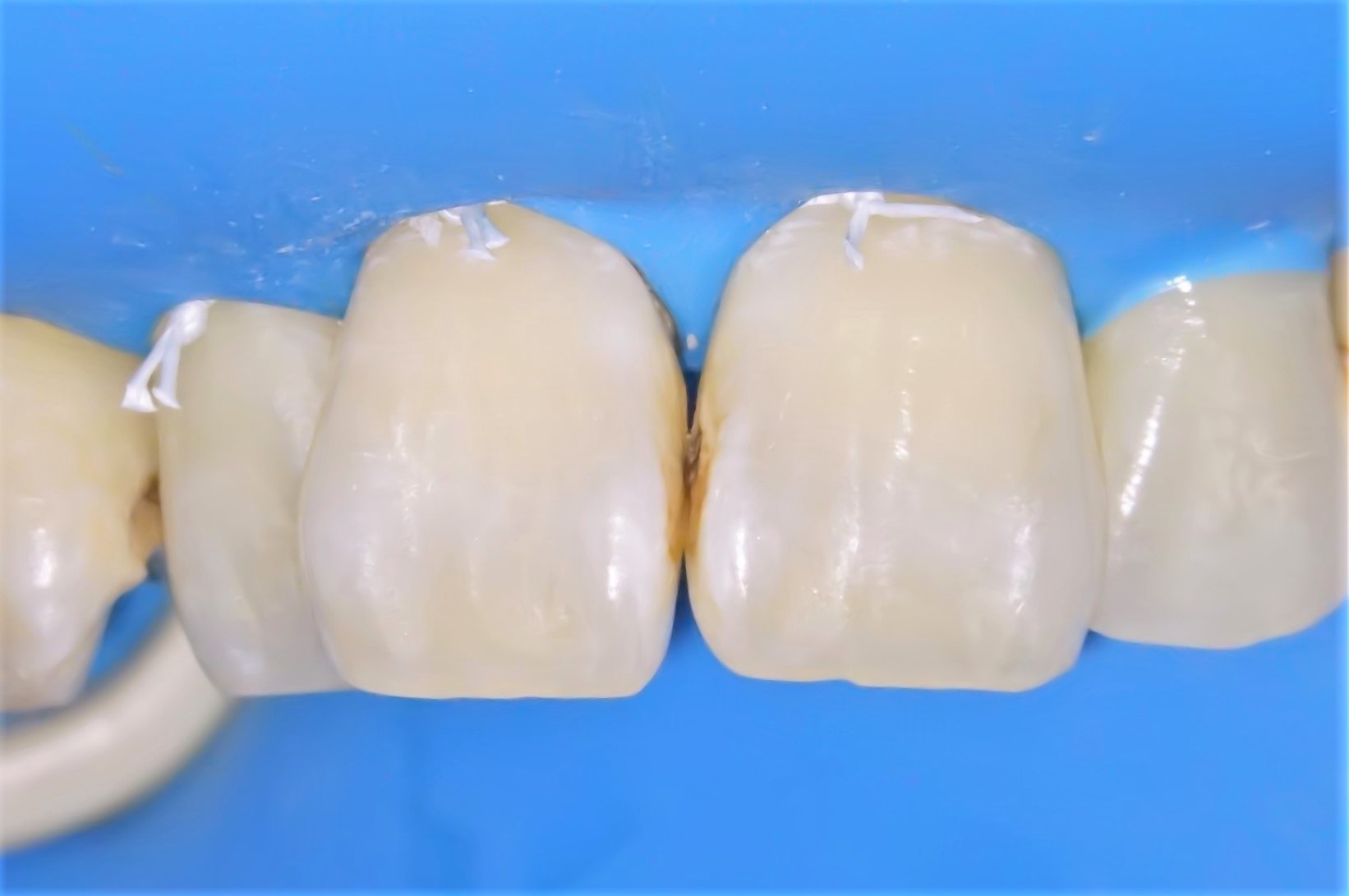 虫歯治療3治療方法01