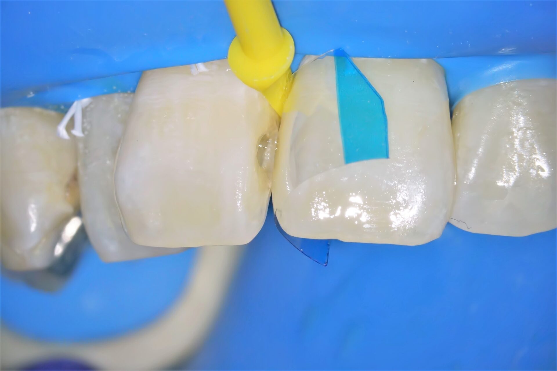 虫歯治療3治療方法03