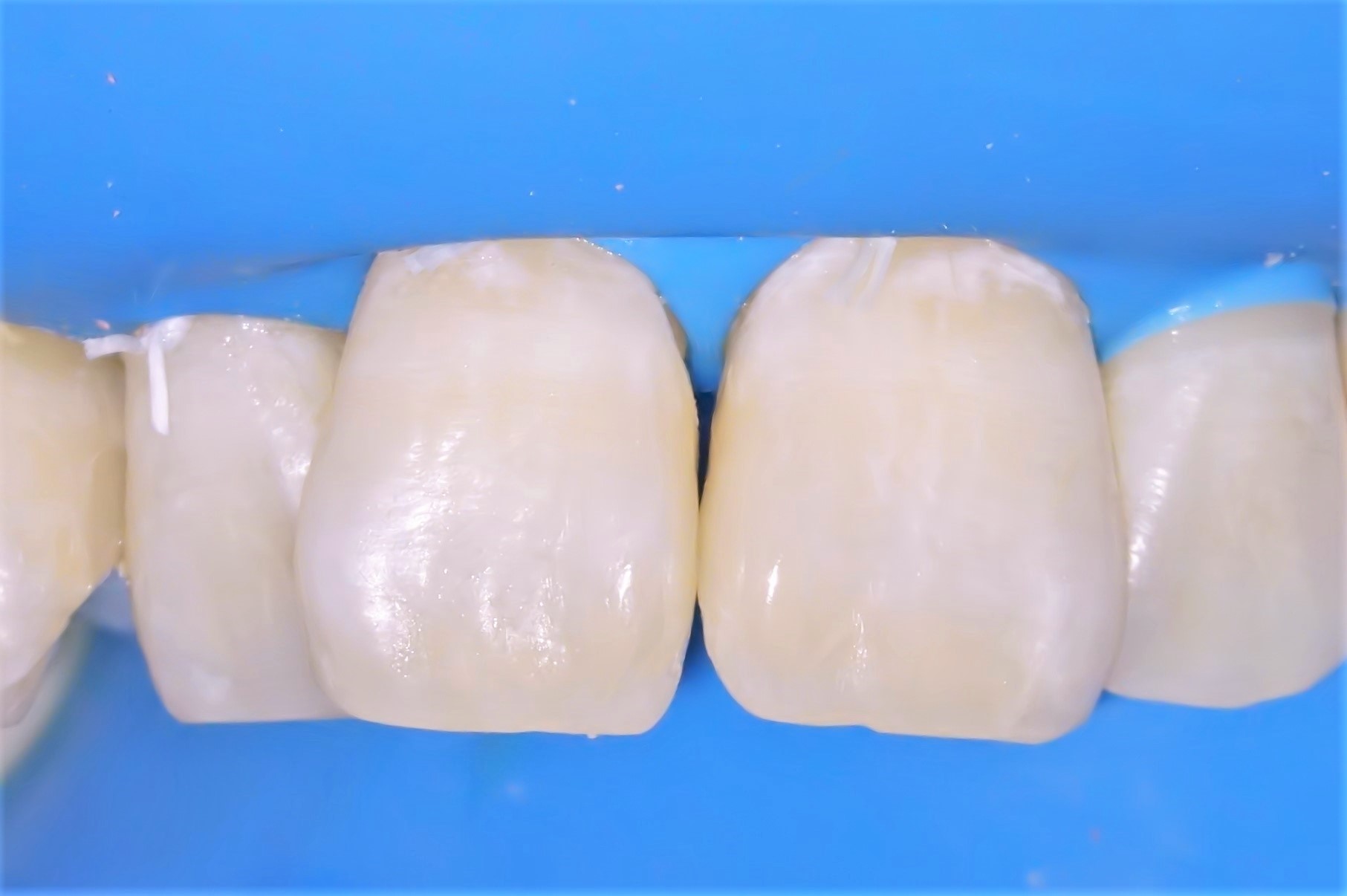 虫歯治療3治療方法05