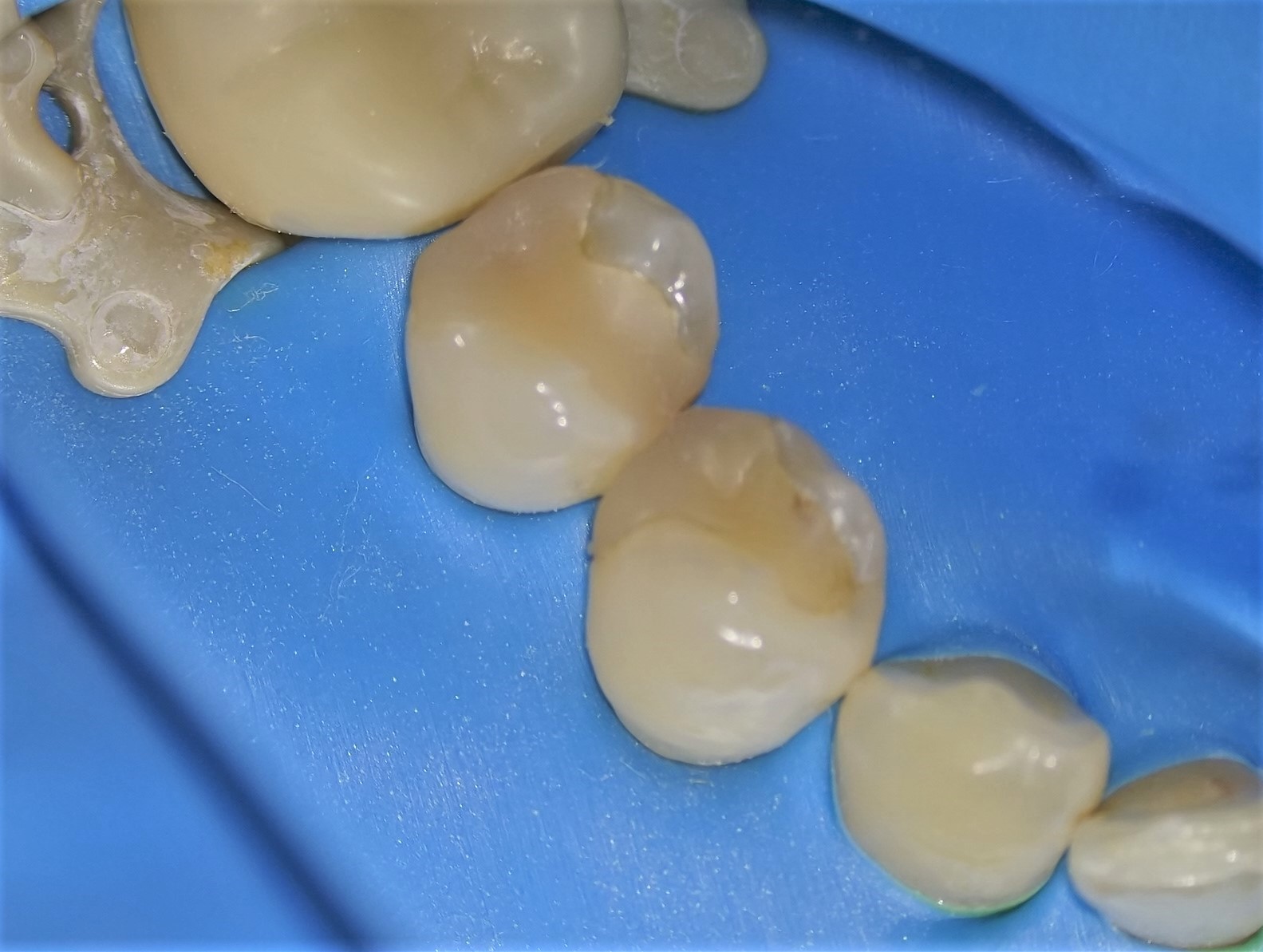 虫歯治療5治療方法01