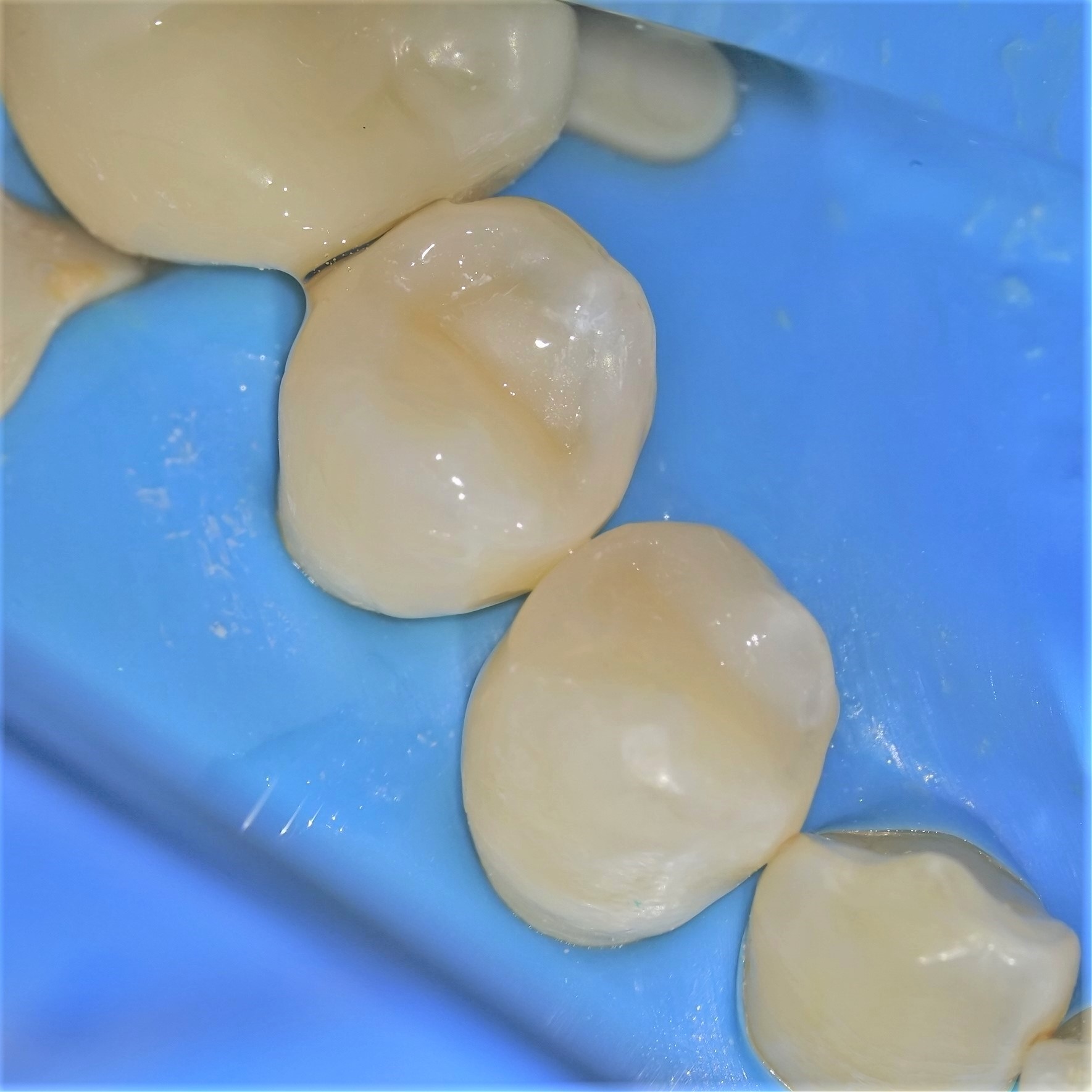 虫歯治療5治療方法04