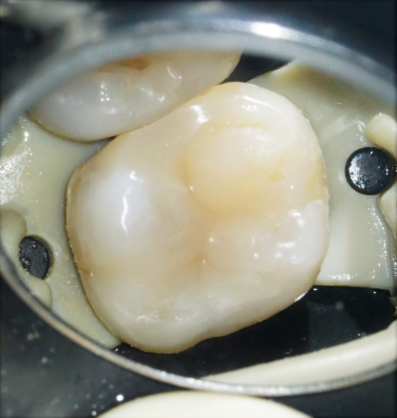 虫歯治療4治療方法06